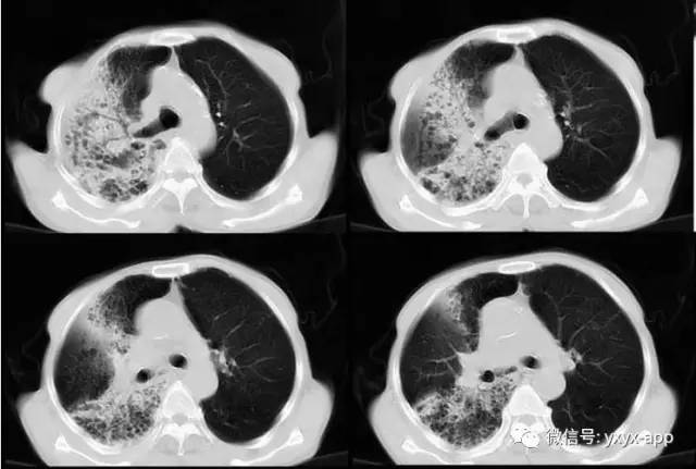 【病例】肺真菌病1例CT影像表现 【病例】肺真菌病1例CT影像表现
