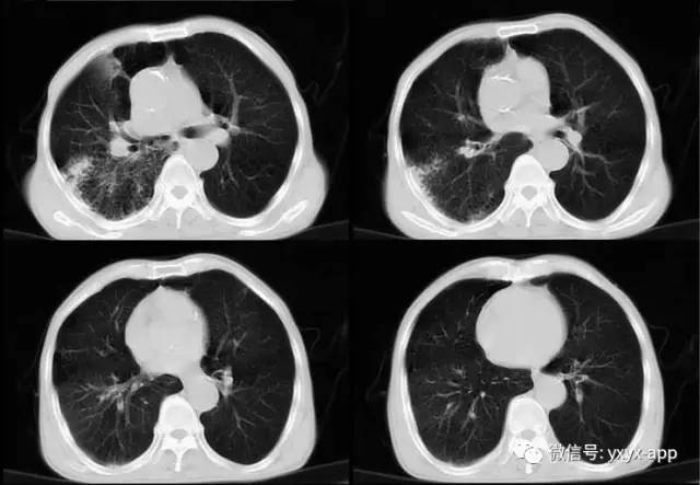 【病例】肺真菌病1例CT影像表现 【病例】肺真菌病1例CT影像表现