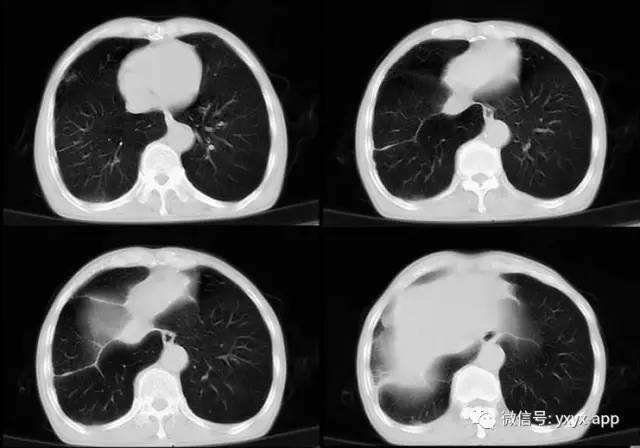 【病例】肺真菌病1例CT影像表现 【病例】肺真菌病1例CT影像表现