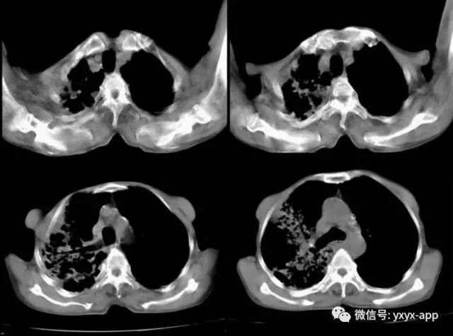 【病例】肺真菌病1例CT影像表现 【病例】肺真菌病1例CT影像表现