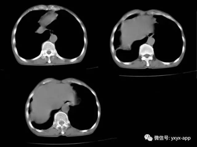 【病例】肺真菌病1例CT影像表现 【病例】肺真菌病1例CT影像表现