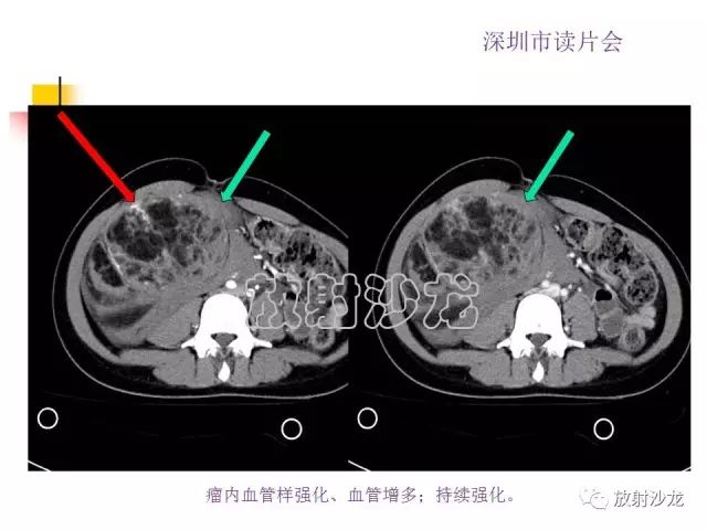 【病例】右肾血管平滑肌脂肪瘤1例CT影像表现