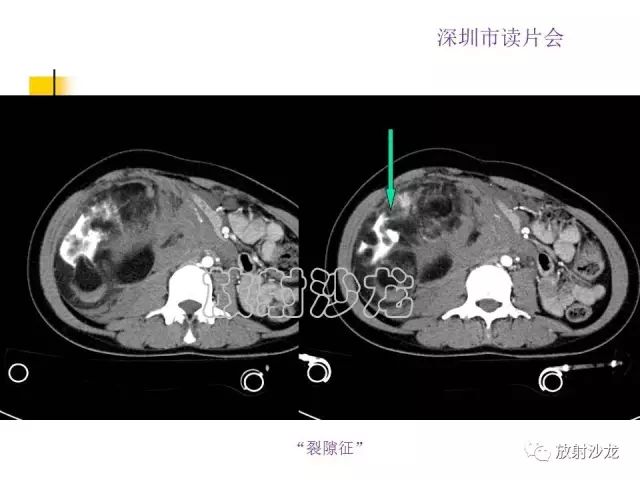 【病例】右肾血管平滑肌脂肪瘤1例CT影像表现