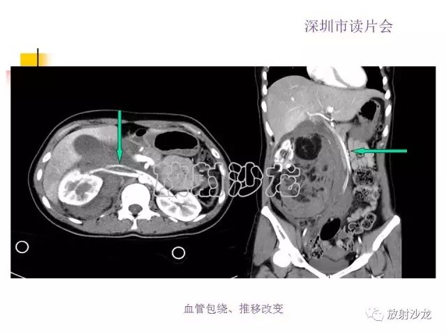 【病例】右肾血管平滑肌脂肪瘤1例CT影像表现