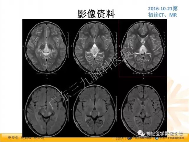 【病例】松果体成熟型囊性畸胎瘤1例CT及MR