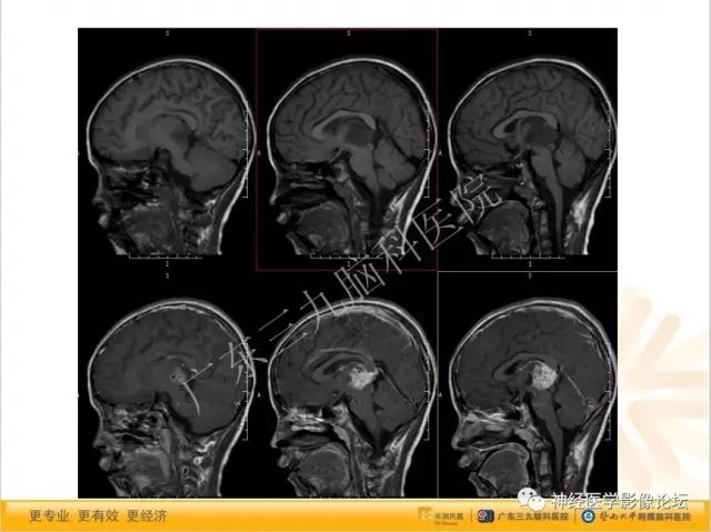 【病例】松果体成熟型囊性畸胎瘤1例CT及MR