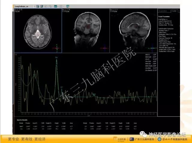 【病例】松果体成熟型囊性畸胎瘤1例CT及MR
