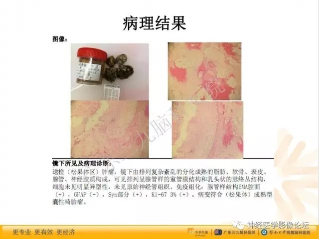 【病例】松果体成熟型囊性畸胎瘤1例CT及MR