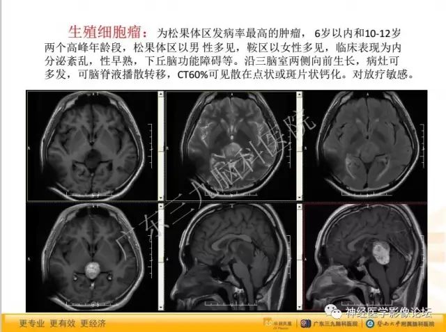 【病例】松果体成熟型囊性畸胎瘤1例CT及MR