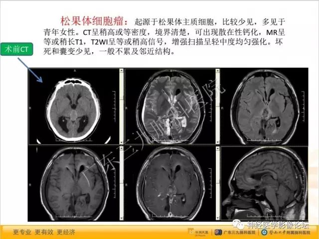 【病例】松果体成熟型囊性畸胎瘤1例CT及MR