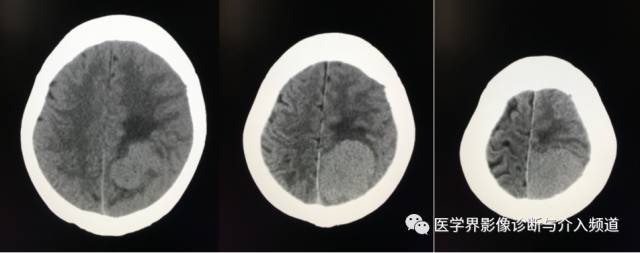 【病例】纤维型脑膜瘤2例影像诊断与鉴别 【病例】纤维型脑膜瘤2例影像诊断与鉴别
