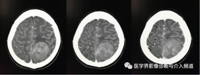 【病例】纤维型脑膜瘤2例影像诊断与鉴别 【病例】纤维型脑膜瘤2例影像诊断与鉴别
