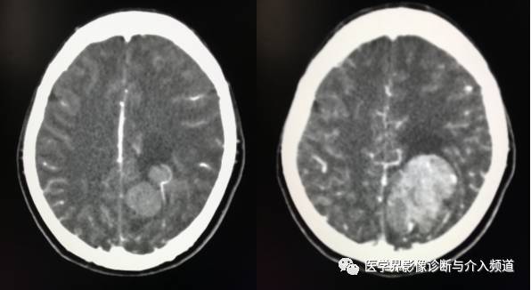 【病例】纤维型脑膜瘤2例影像诊断与鉴别 【病例】纤维型脑膜瘤2例影像诊断与鉴别