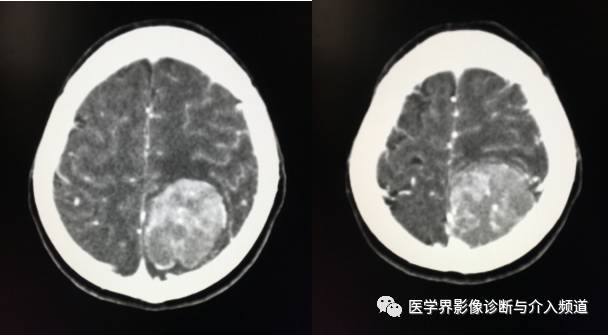 【病例】纤维型脑膜瘤2例影像诊断与鉴别 【病例】纤维型脑膜瘤2例影像诊断与鉴别