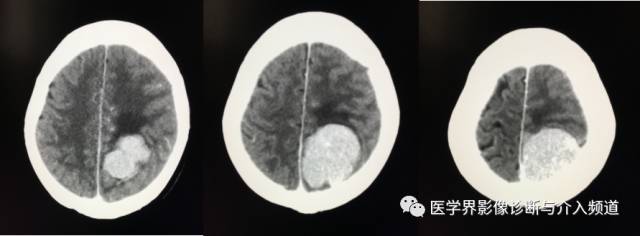 【病例】纤维型脑膜瘤2例影像诊断与鉴别 【病例】纤维型脑膜瘤2例影像诊断与鉴别
