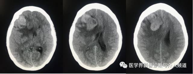 【病例】纤维型脑膜瘤2例影像诊断与鉴别 【病例】纤维型脑膜瘤2例影像诊断与鉴别