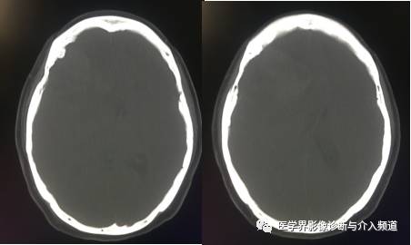 【病例】纤维型脑膜瘤2例影像诊断与鉴别 【病例】纤维型脑膜瘤2例影像诊断与鉴别