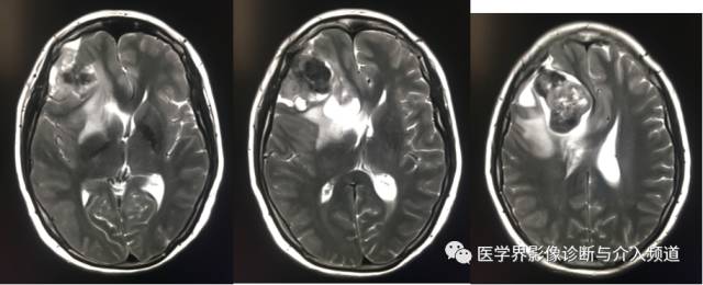 【病例】纤维型脑膜瘤2例影像诊断与鉴别