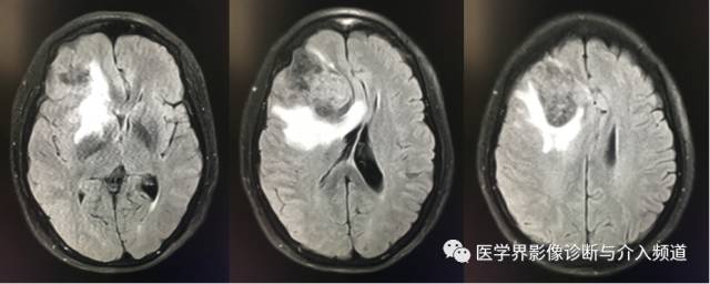 【病例】纤维型脑膜瘤2例影像诊断与鉴别 【病例】纤维型脑膜瘤2例影像诊断与鉴别