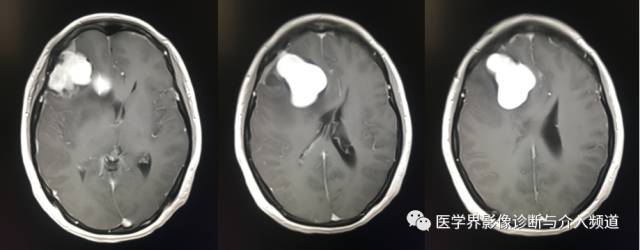 【病例】纤维型脑膜瘤2例影像诊断与鉴别 【病例】纤维型脑膜瘤2例影像诊断与鉴别