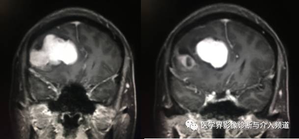 【病例】纤维型脑膜瘤2例影像诊断与鉴别 【病例】纤维型脑膜瘤2例影像诊断与鉴别
