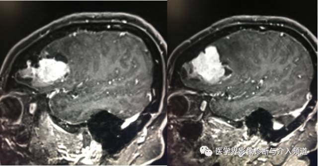 【病例】纤维型脑膜瘤2例影像诊断与鉴别 【病例】纤维型脑膜瘤2例影像诊断与鉴别