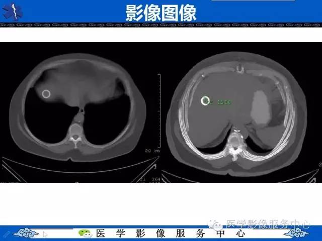 【病例】肝区异位节育器1例CT