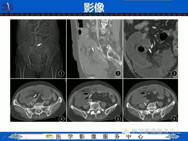 【病例】肝区异位节育器1例CT
