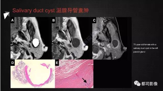 【PPT】腮腺囊性病变影像诊断