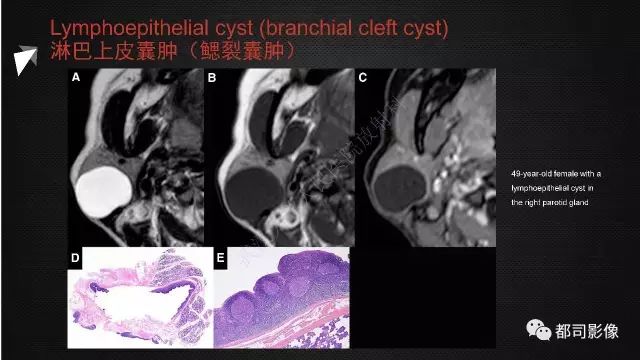 【PPT】腮腺囊性病变影像诊断