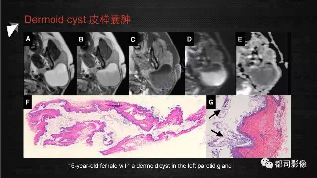 【PPT】腮腺囊性病变影像诊断