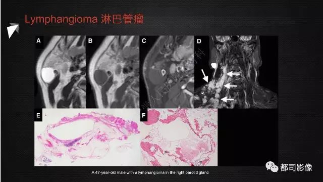 【PPT】腮腺囊性病变影像诊断