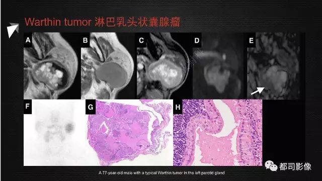 【PPT】腮腺囊性病变影像诊断
