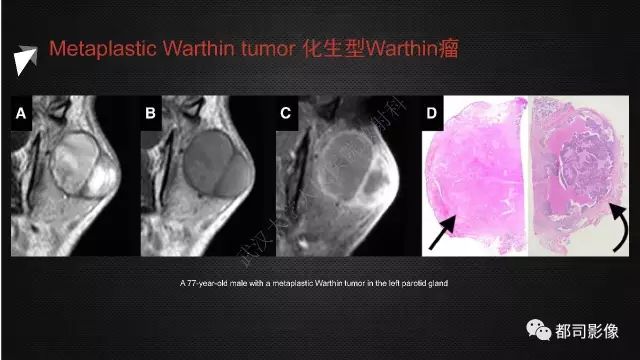 【PPT】腮腺囊性病变影像诊断