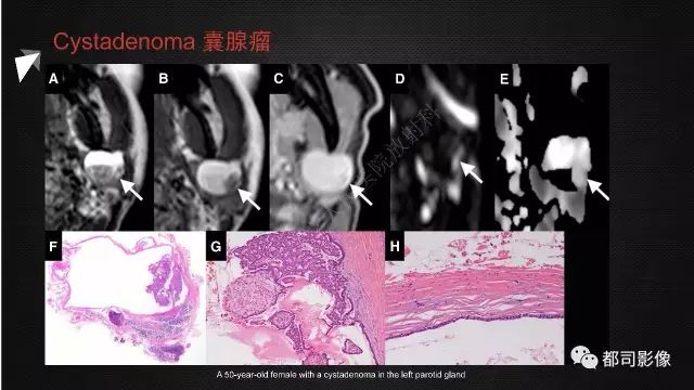 【PPT】腮腺囊性病变影像诊断