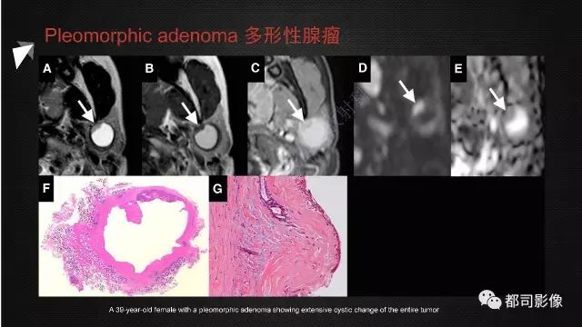 【PPT】腮腺囊性病变影像诊断