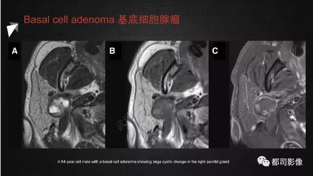 【PPT】腮腺囊性病变影像诊断
