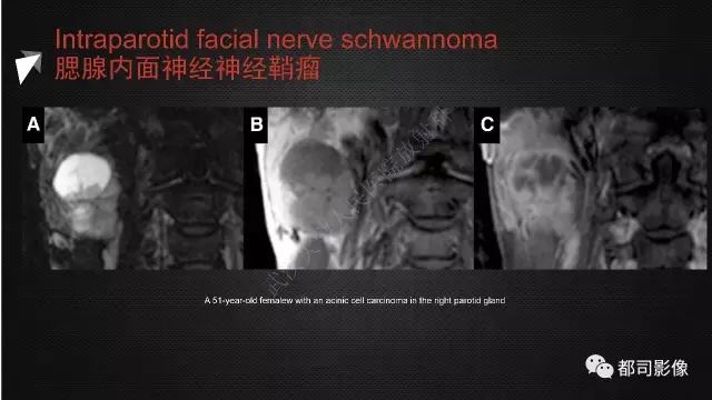 【PPT】腮腺囊性病变影像诊断