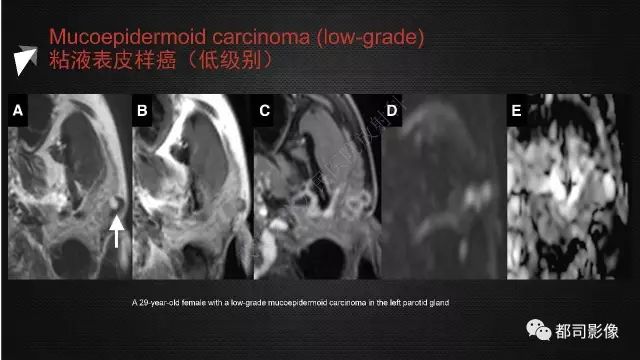 【PPT】腮腺囊性病变影像诊断