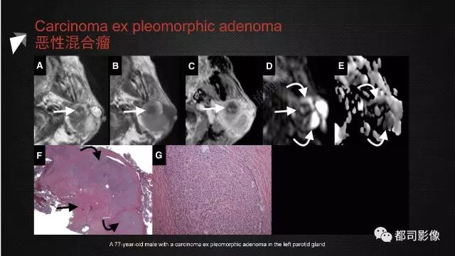 【PPT】腮腺囊性病变影像诊断