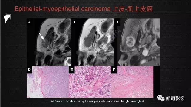 【PPT】腮腺囊性病变影像诊断