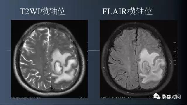 【病例】脑内环形强化3例影像诊断与分析