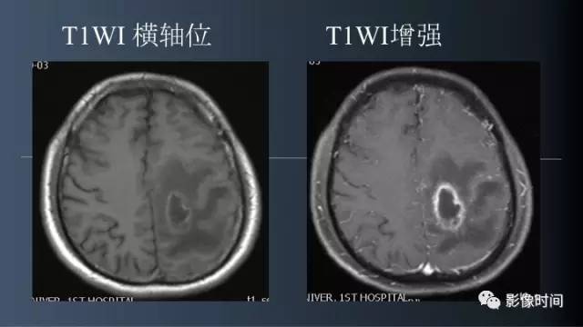 【病例】脑内环形强化3例影像诊断与分析