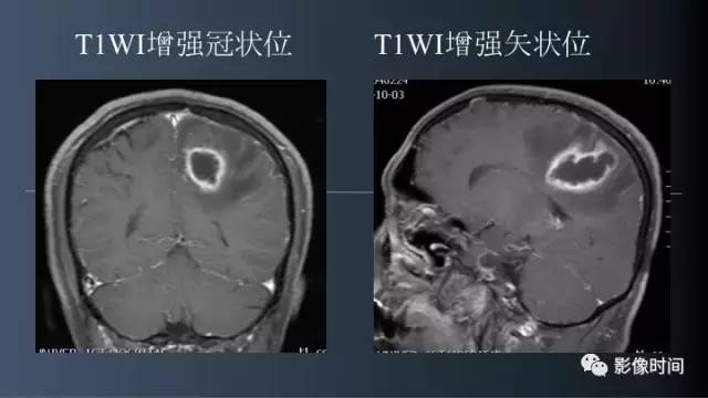 【病例】脑内环形强化3例影像诊断与分析