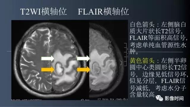【病例】脑内环形强化3例影像诊断与分析