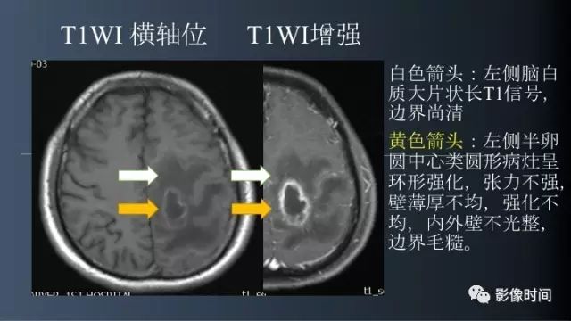 【病例】脑内环形强化3例影像诊断与分析