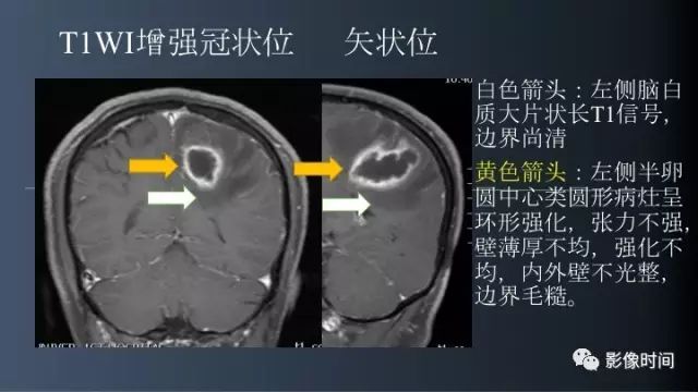 【病例】脑内环形强化3例影像诊断与分析