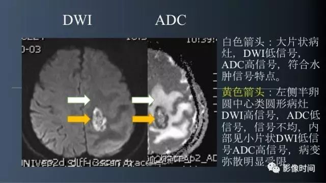 【病例】脑内环形强化3例影像诊断与分析