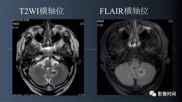 【病例】脑内环形强化3例影像诊断与分析