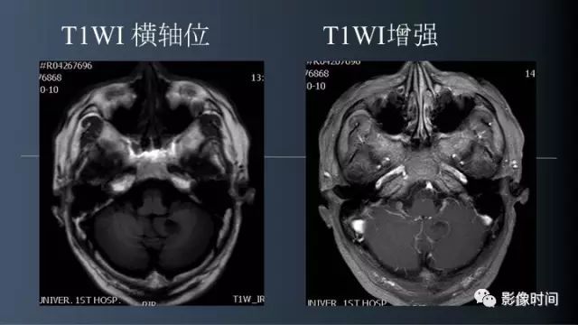 【病例】脑内环形强化3例影像诊断与分析